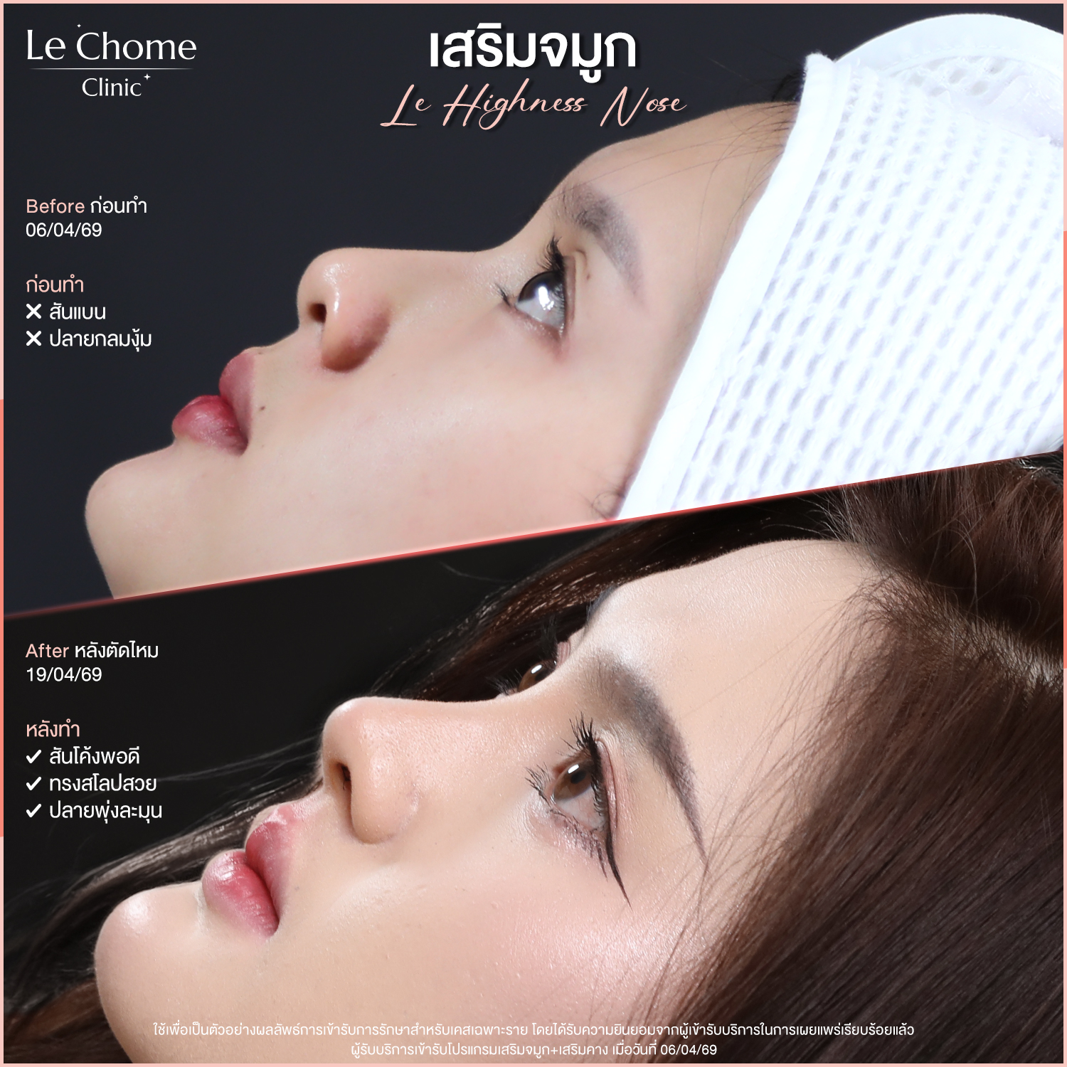 เสริมจมูก