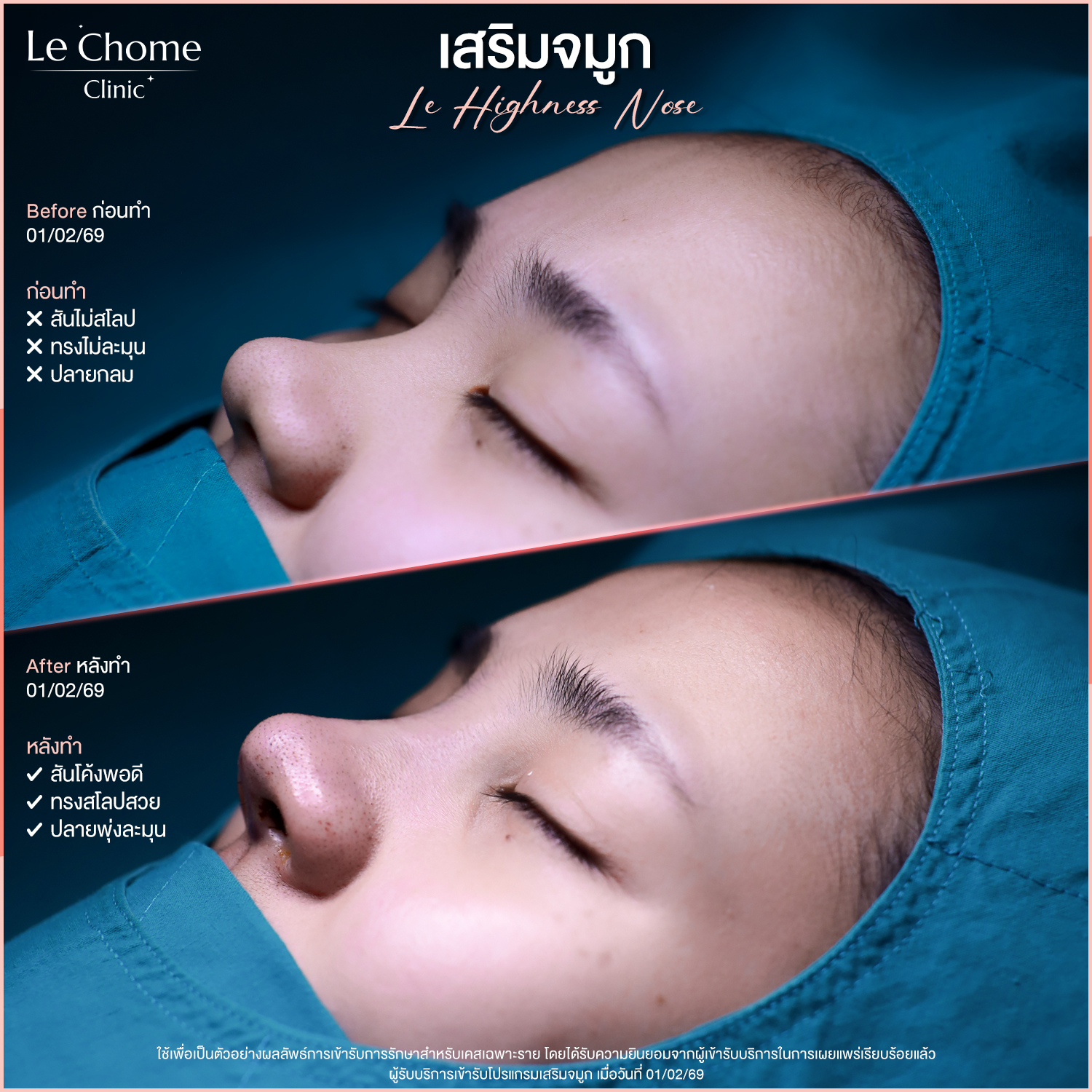 รีวิวเสริมจมูก — เสริมจมูก