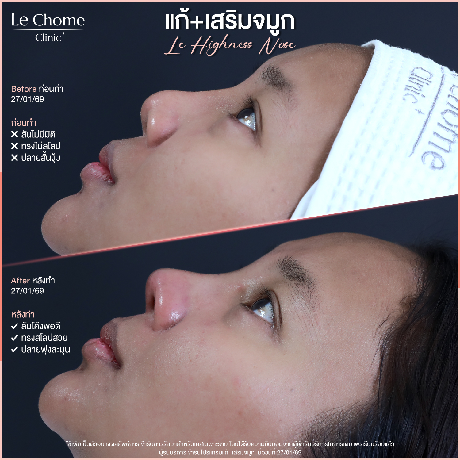 รีวิวเสริมจมูก — แก้+เสริมจมูก