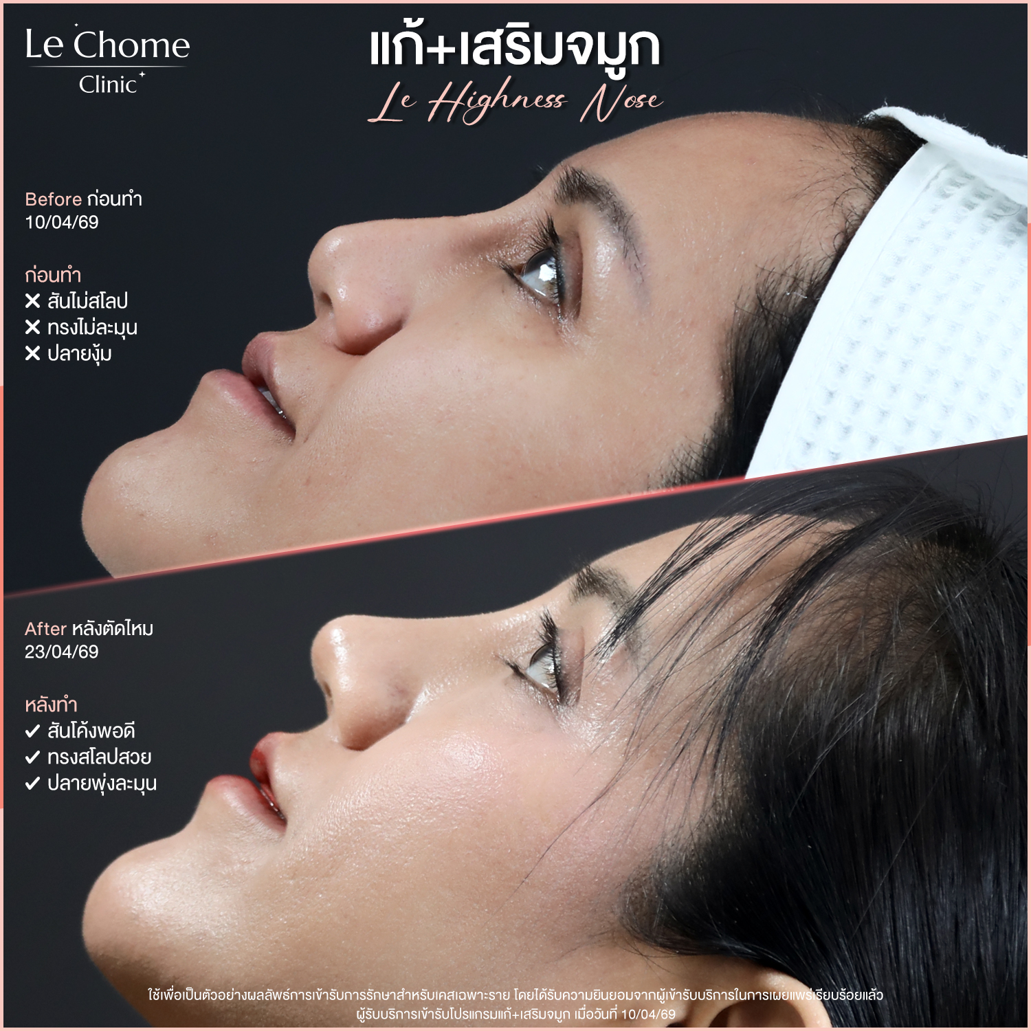 แก้+เสริมจมูก